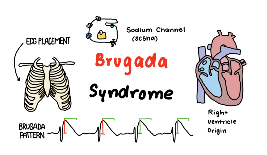 Brugada Syndrome 